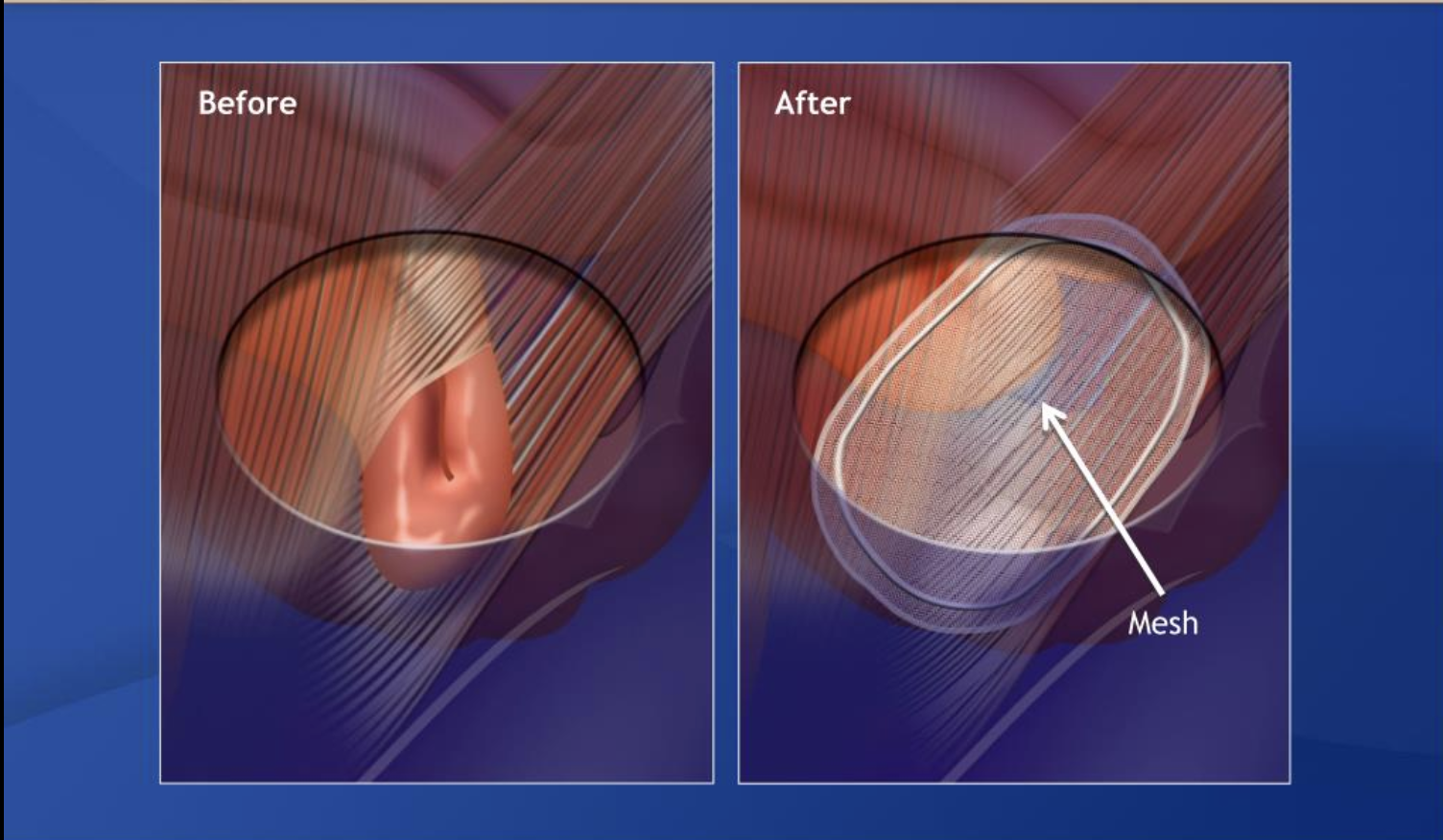 Open Inguinal Hernia Repair