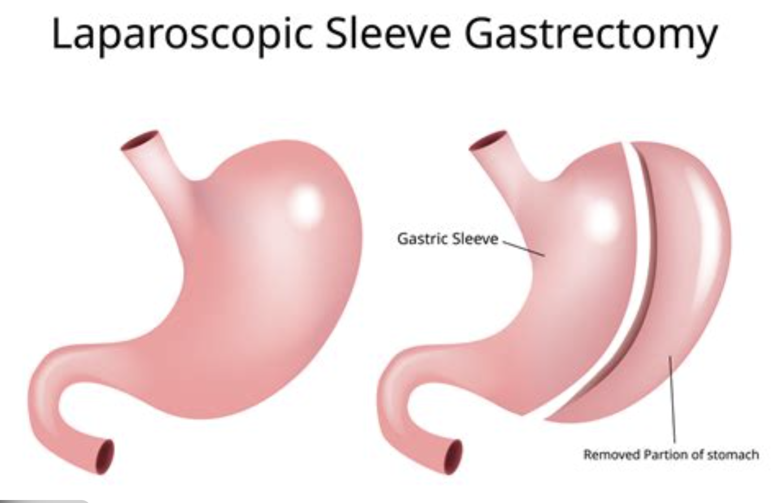 Laparoscopic Sleeve Gastrectomy (Weight Loss Surgery)